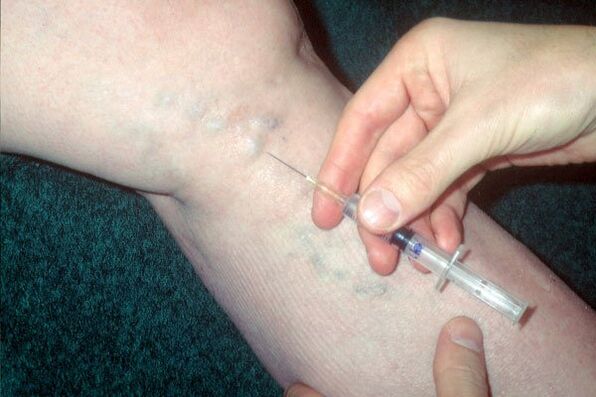 szkleroterápia visszér kezelésére