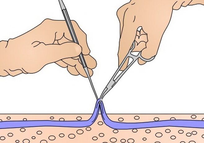 visszér eltávolítása